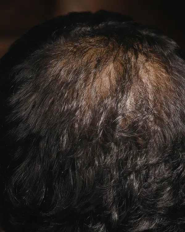 Top view of thinning hair on the crown